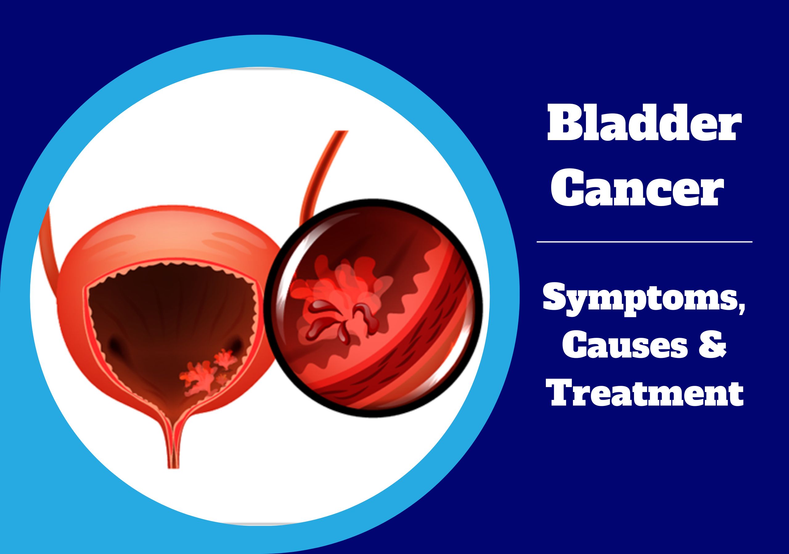 Bladder Cancer: A Comprehensive Exploration